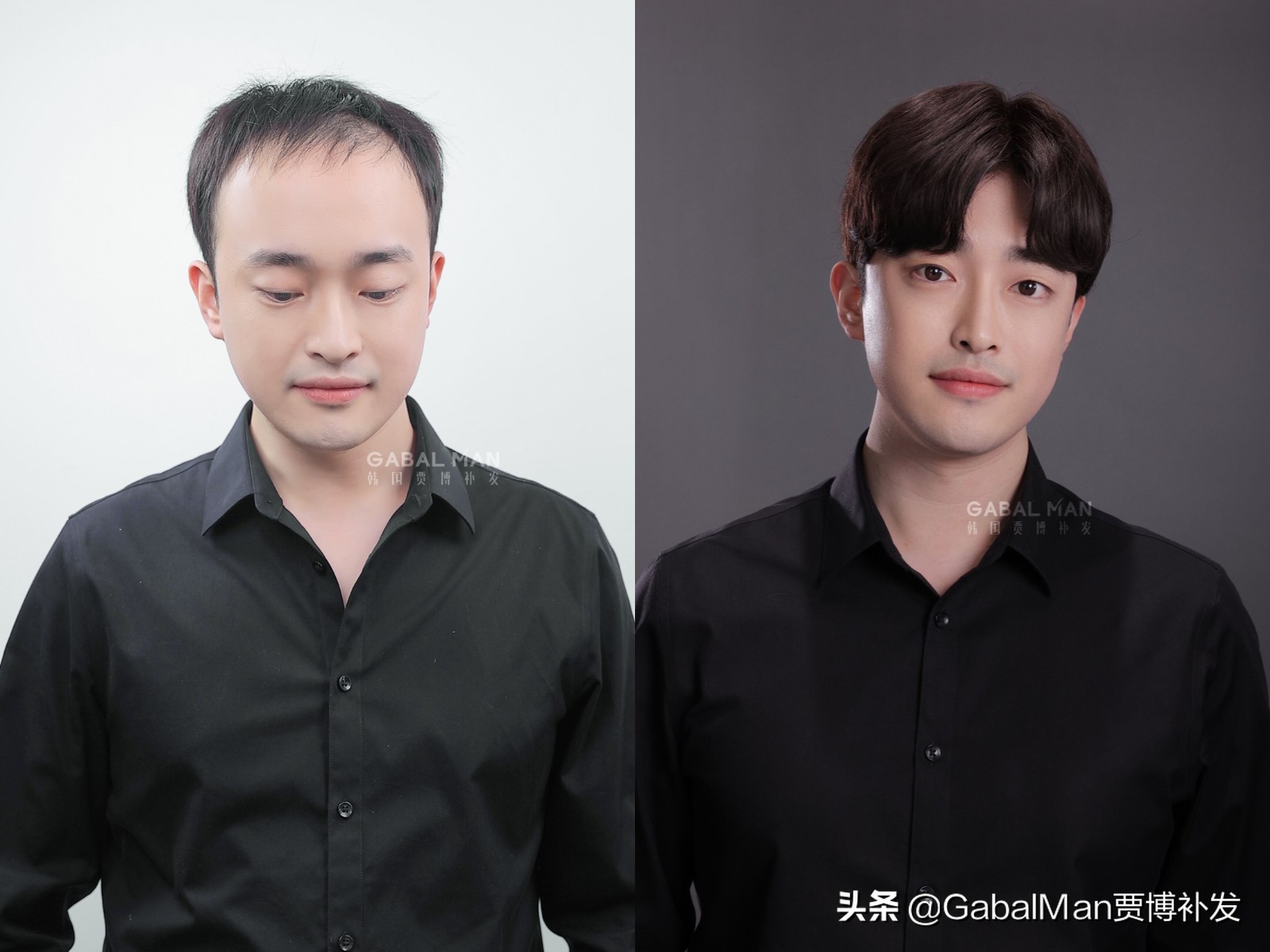 拯救发际线的最佳方法,如何拯救发际线过高