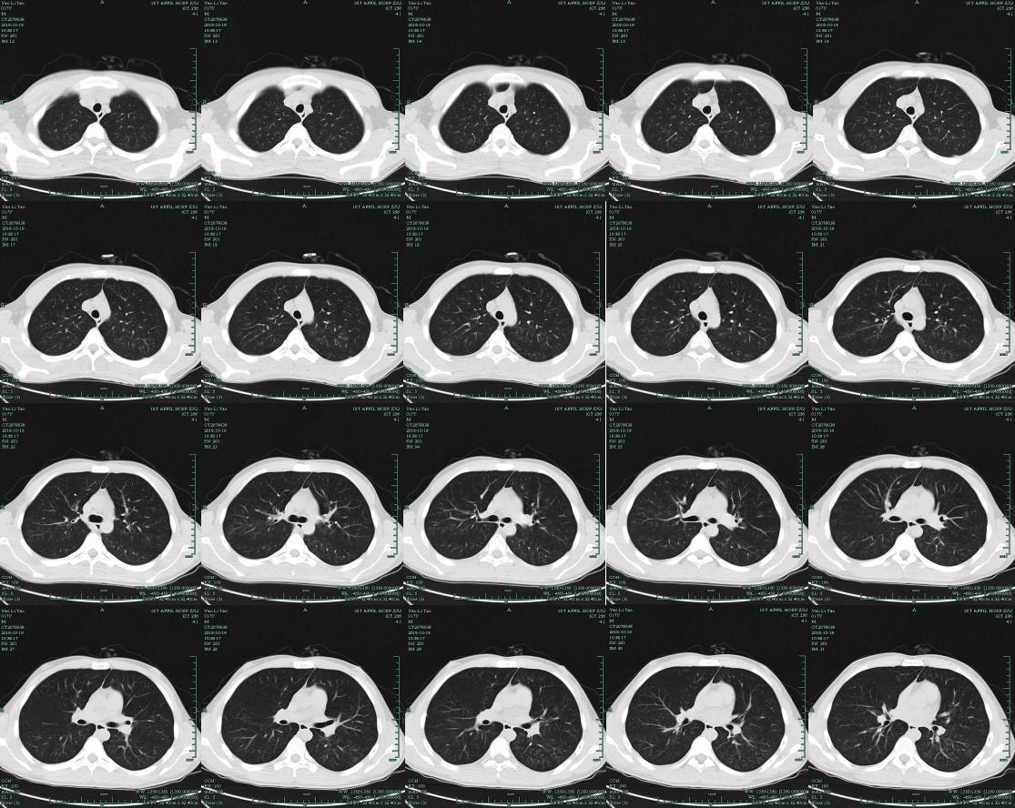 mngs病原检测的优势,mngs真的可靠吗