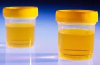 肾病综合征尿蛋白阴性与阳性区别,尿蛋白十一尿潜血阳性是肾病吗