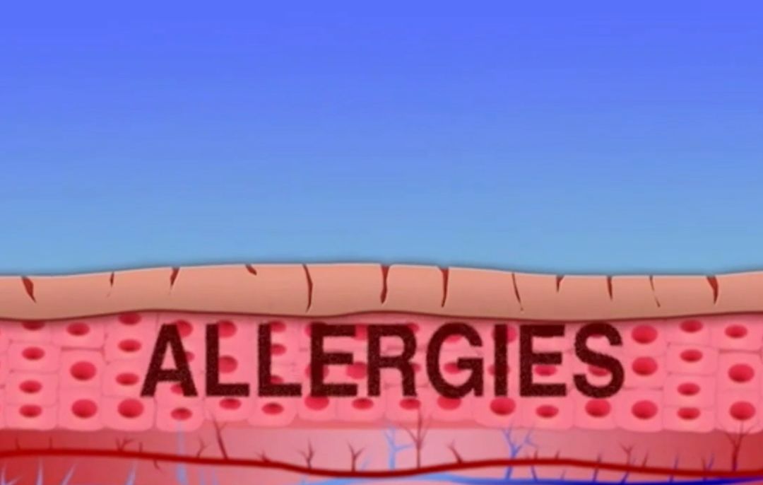 宝宝湿疹要注意保湿吗,儿童过敏性哮喘鼻炎湿疹怎么办