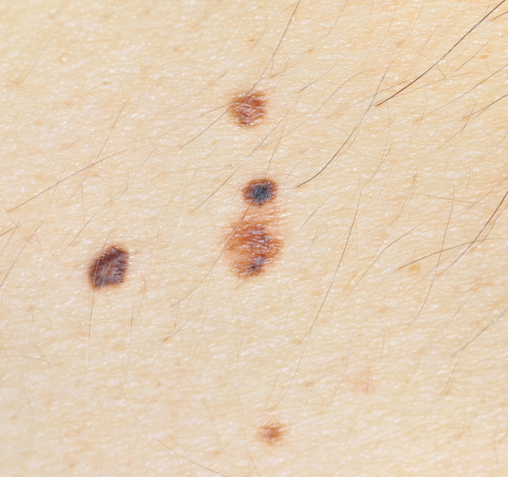 色素痣为什么都建议去除,为什么色素痣会越来越多