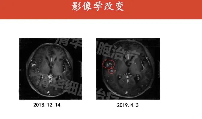 肺癌晚期活不了多久的症状,肺癌晚期生命只剩下六个月