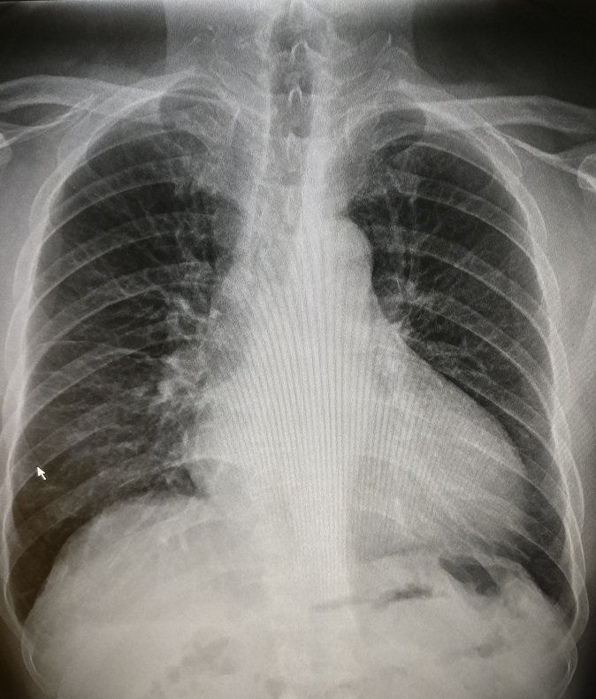 循环系统胸片,体循环和肺循环临床表现