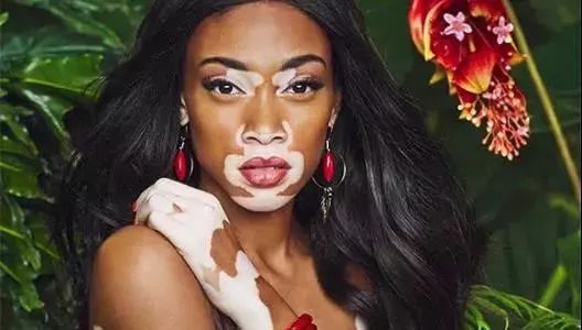 白癜风患者应该怎么树立信心,白癜风患者坚定祛白信心