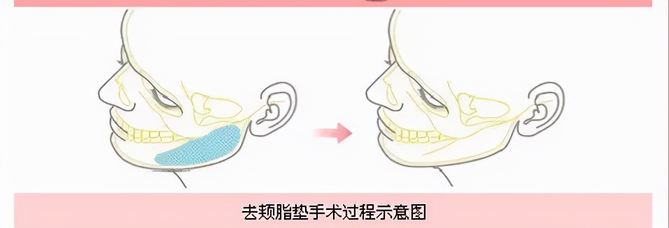 肉方脸如何改善,骨骼型短方脸适合什么发型显温柔