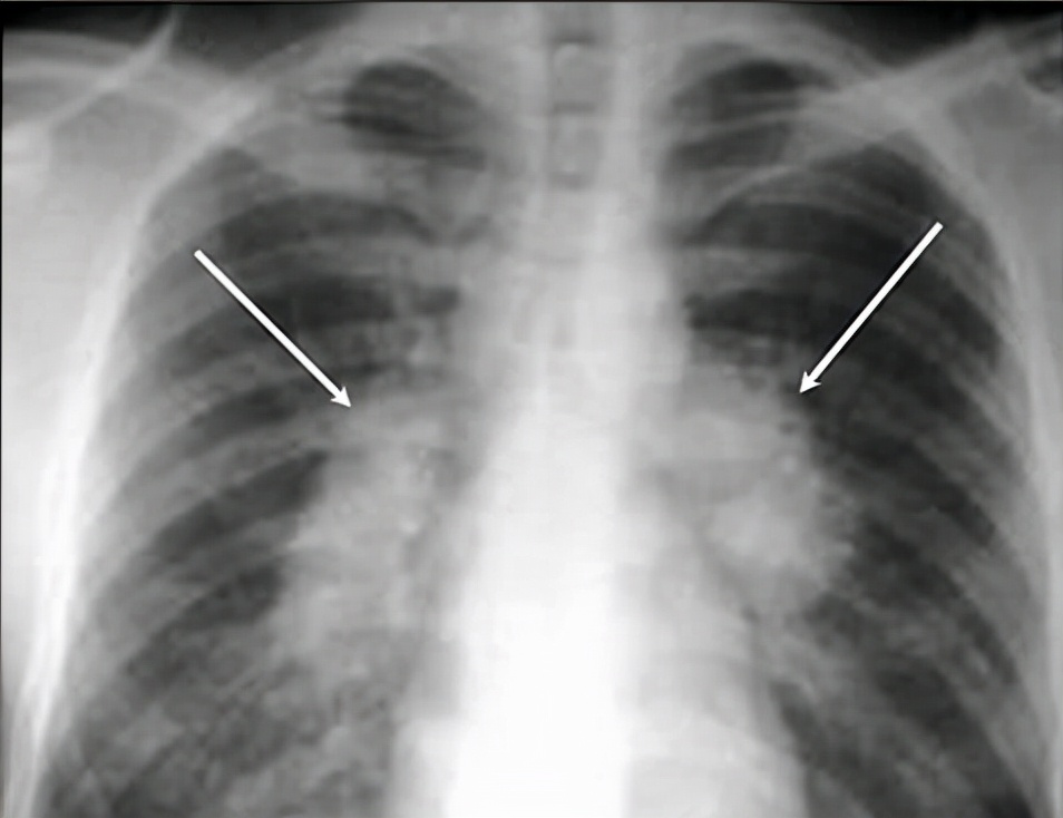 x光ctb超核磁的区别,x光b超ct区别