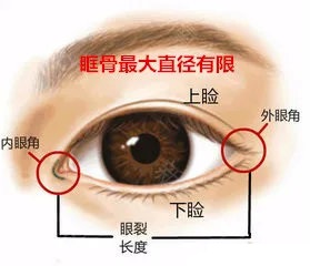 开外眼角会有哪些后遗症,开外眼角的手术后的图片