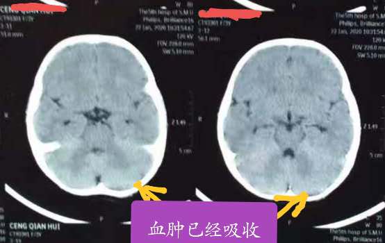 硬膜外血肿意识清醒需要手术吗,急性硬膜外血肿可做什么检查