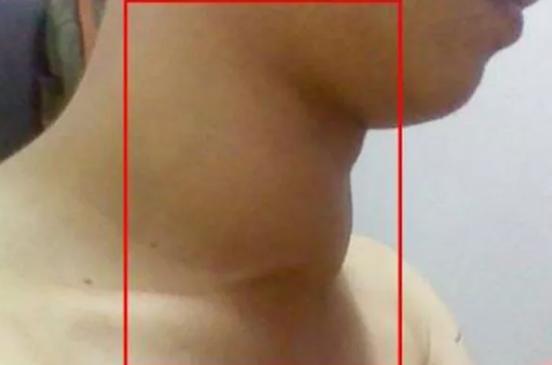 怎么帮助甲亢患者调整心态,如何预防甲亢最有效的方法