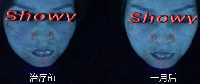 冬季护肤之祛斑正当时——光电治疗