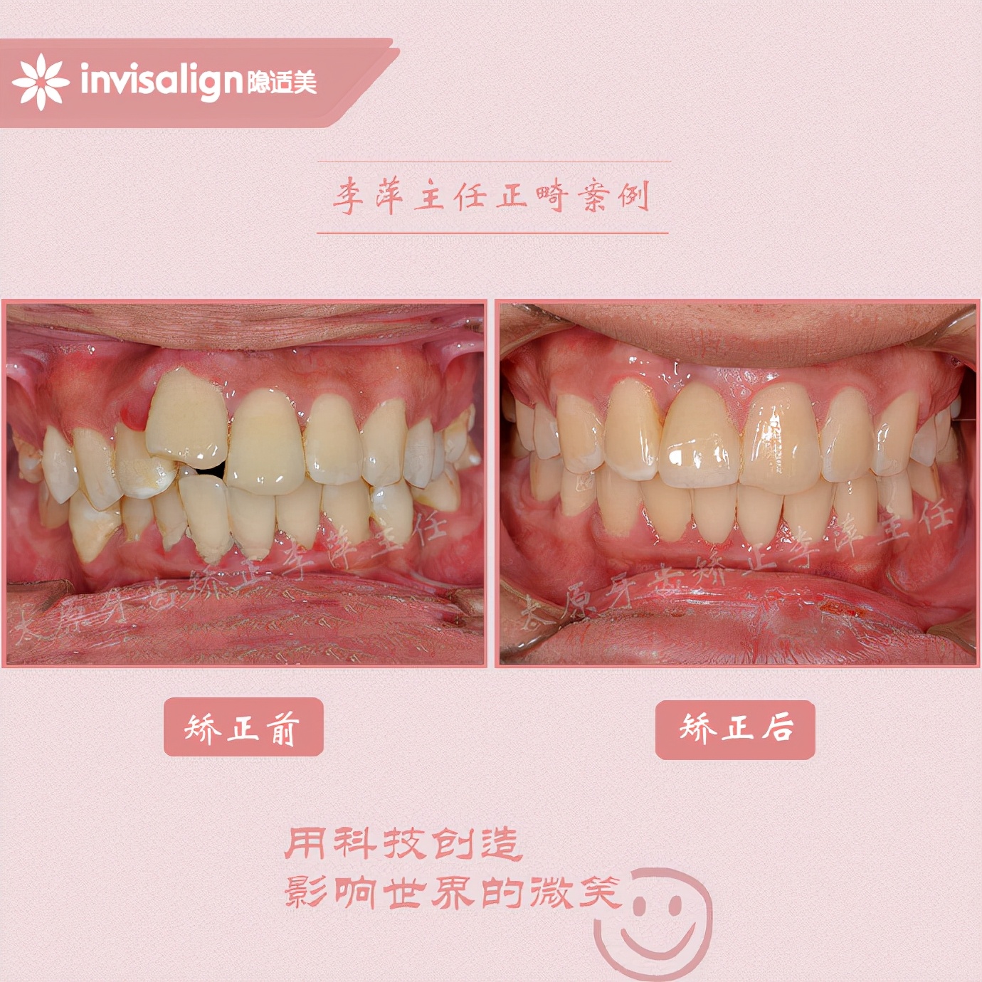 重度牙齿拥挤矫正经历,太原矫正牙齿需要多久