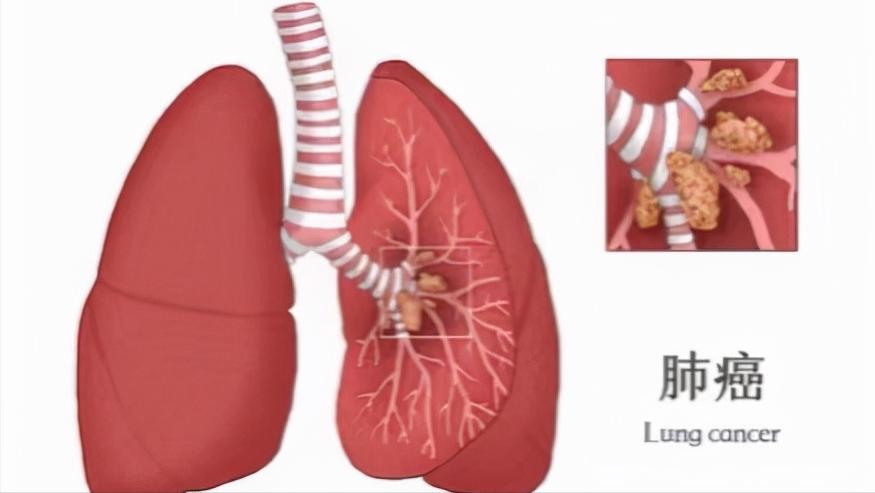 肺癌患者说的感人的话,谈谈肺癌的主要临床表现