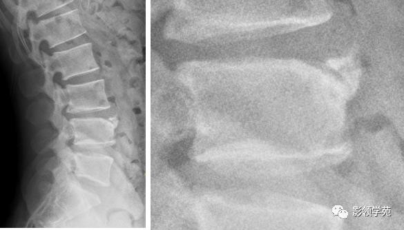 桡骨远端骨折引起尺骨变异,撕脱骨折一个月无明显骨痂形成