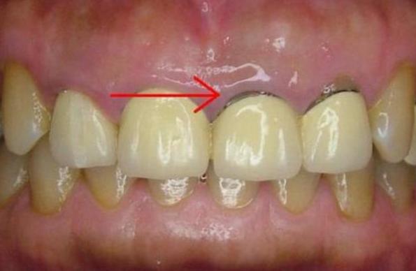 做烤瓷牙的利弊与危害,烤瓷牙失败的原因及解决方法