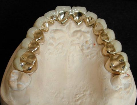 各种假牙价格一览表,假牙十大品牌价格表