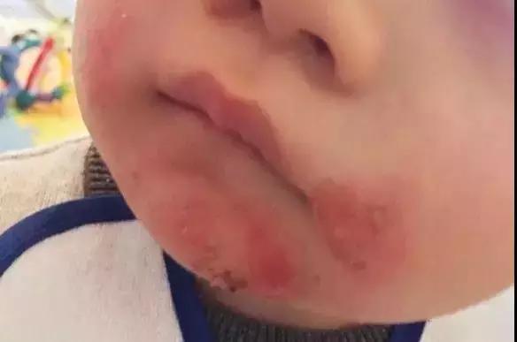 宝宝口水疹为什么会长到脸上去,婴儿口水疹用什么抹脸比较好