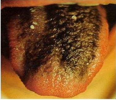 从舌头看身体状况拍照,如何看舌头判断孩子身体状况