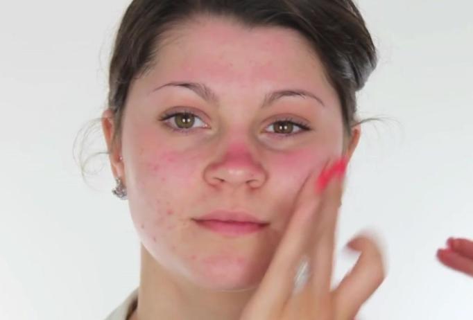 激光美白小妙招,激光美白哪种效果最好