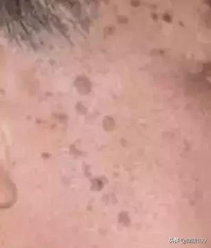 脸上祛斑最简单的方法,想要脸上光滑没瑕疵