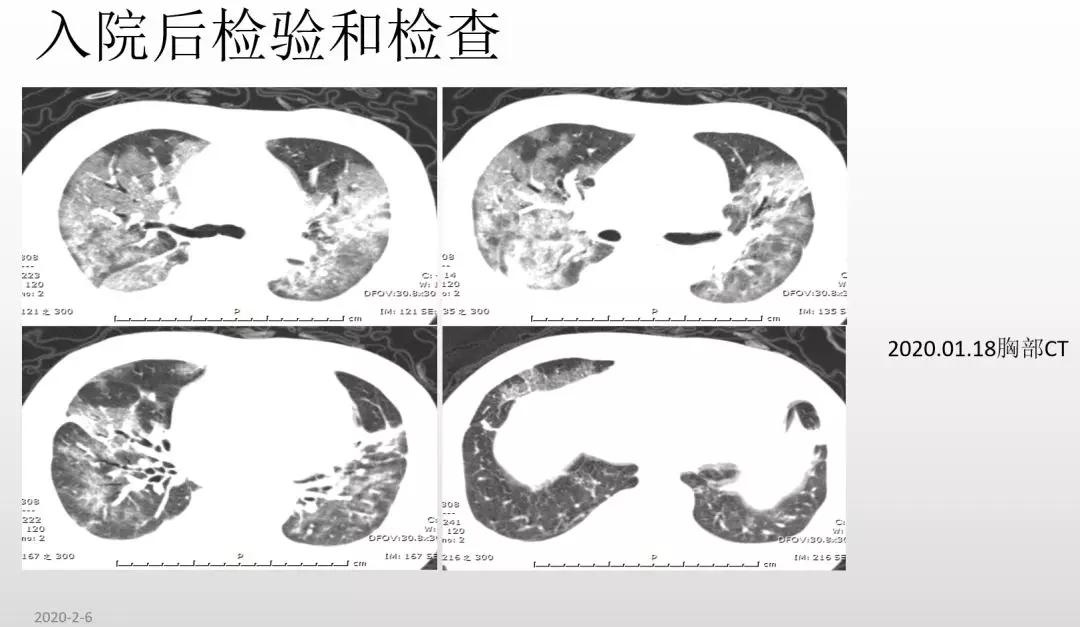 赵建平:重症CAP存在过度炎症反应时合理应用激素可减轻