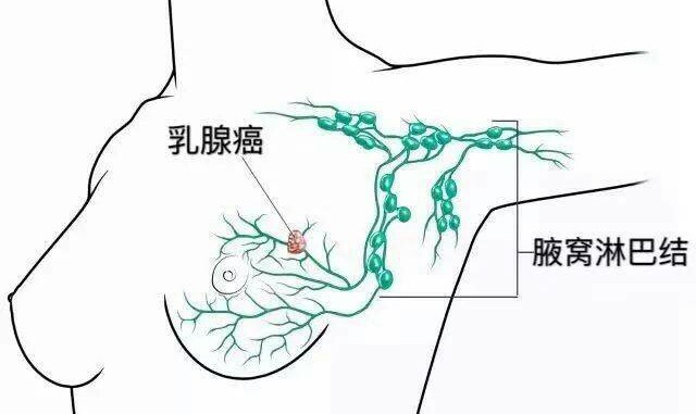 乳腺癌术后患侧上肢肿胀，什么原因呢？