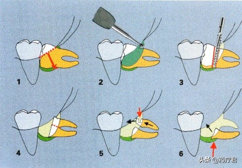 拔智齿大牙松动,拔智齿大牙松动怎么办