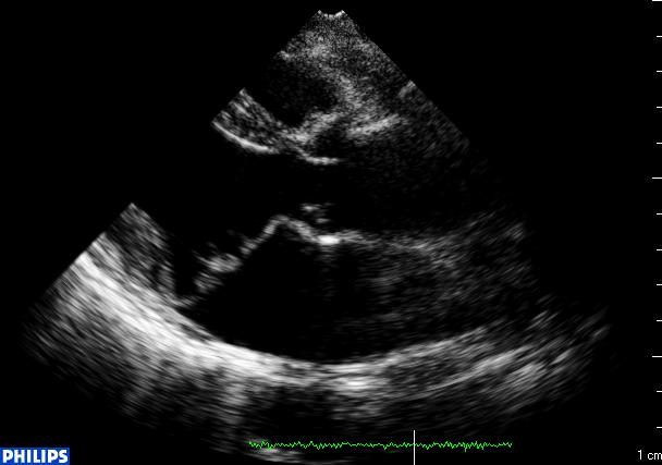 类风湿关节炎能引起心脏疾病吗,类风湿心脏病自愈的最简单方法