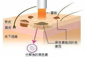 重要|雀斑和*褐斑黄**的注意事项