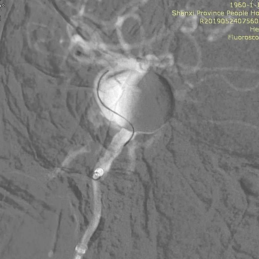 山西省人民医院任少华教授,山西省人民医院任少华