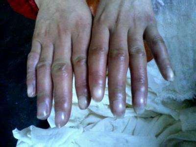 冻伤是不可逆的真的假的,低温冻伤的后果