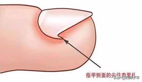 指甲老往肉里长一碰就痛怎么办,趾甲根部嵌甲怎么办