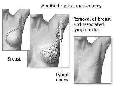 若有专家还在用这种方式治疗乳腺癌，不要犹豫，立马举报他