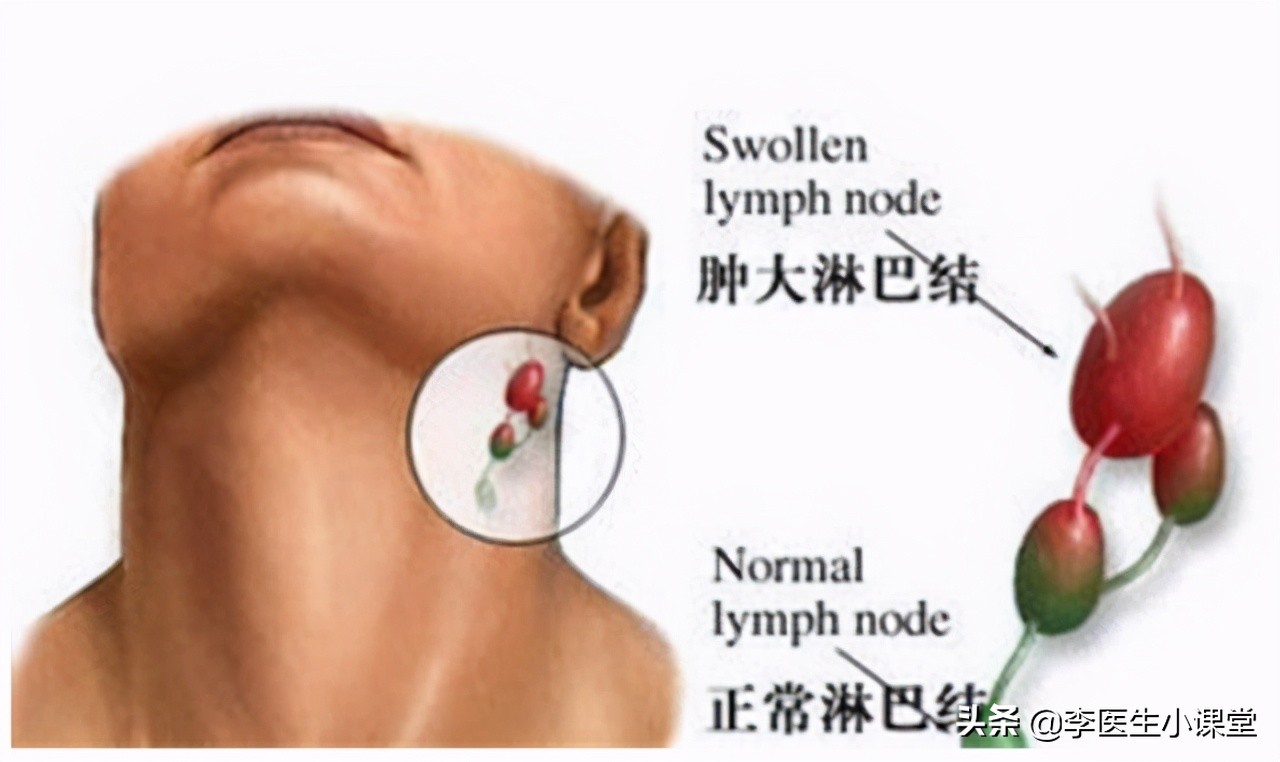 感染引起的淋巴结肿大怎么办,感染引起的恶性肿瘤