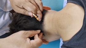 神经根型颈椎病针灸推拿能治愈吗,椎动脉型颈椎病怎么推拿针灸