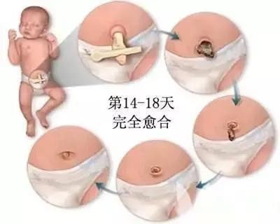 脐部护理的介绍,新生儿脐部护理