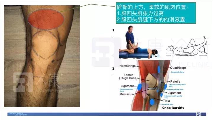 前叉术后两个月伤口处伸直会疼,前叉术后第11天的状态