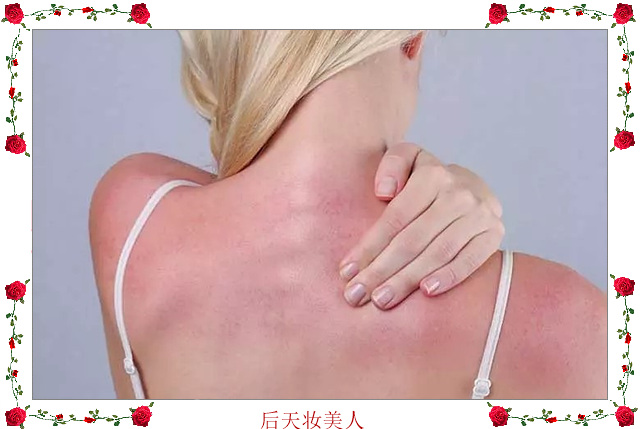 晒后身体晒伤急救擦什么,晒伤后如何保养皮肤晒伤极易过敏