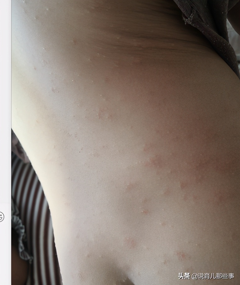 很恐怖的过敏图片,过敏发朋友圈的真实图片