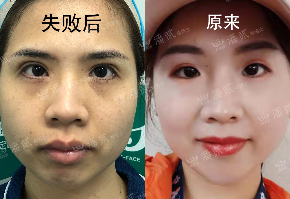 双眼皮手术后眼神凶狠是什么原因,双眼皮手术后显凶