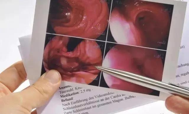 如何看懂胃镜活检报告,胃镜病理活检报告一般需几天