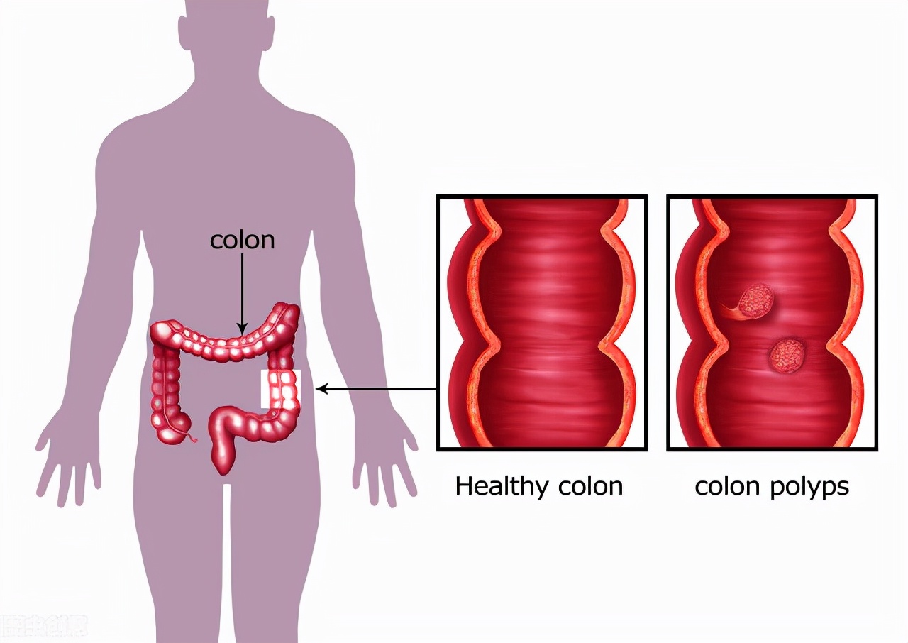 肠癌术后吻合口瘘,肠癌术后如何预防吻合口瘘