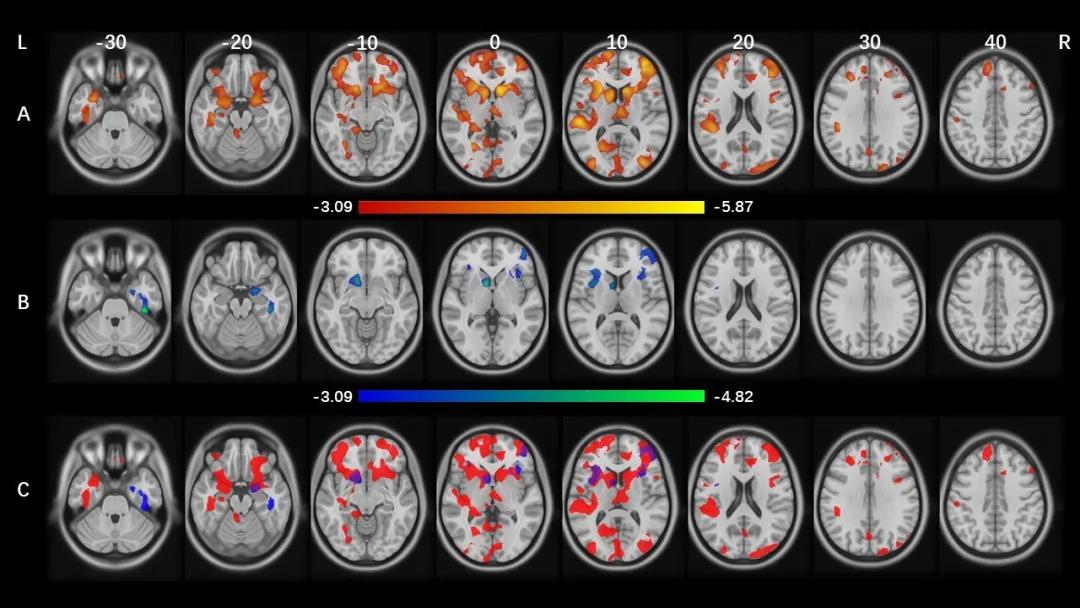 儿童偏头痛会自愈吗怎么治疗呢,儿童发生偏头痛用哪些穴位治疗