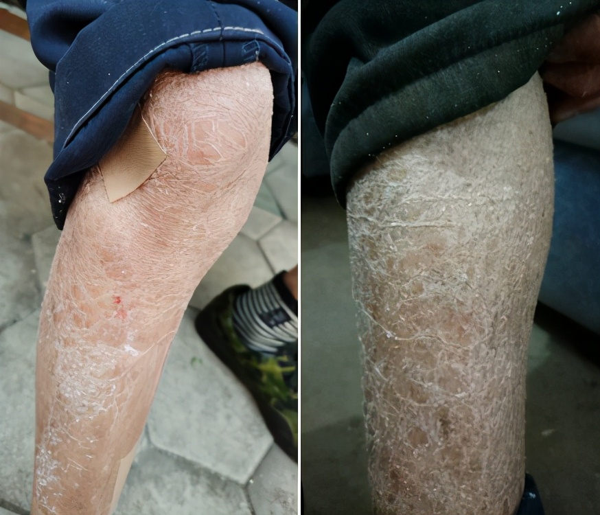 秋冬季节皮肤湿疹瘙痒是什么原因,皮肤干燥起湿疹缺乏什么