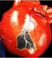 身边很多同事都得了冠心病，到底什么是冠心病？有什么治疗方法？