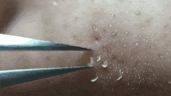 一招教你轻松去黑头,黑头去除小妙招明星