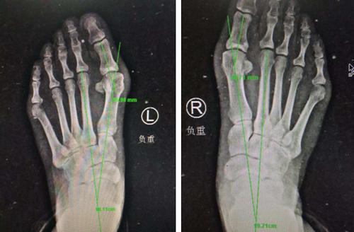 20岁脚趾外翻矫正,踇外翻的处理过程视频