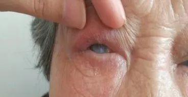 眼整形修复权威科普,科普眼整形手术是个什么手术多图