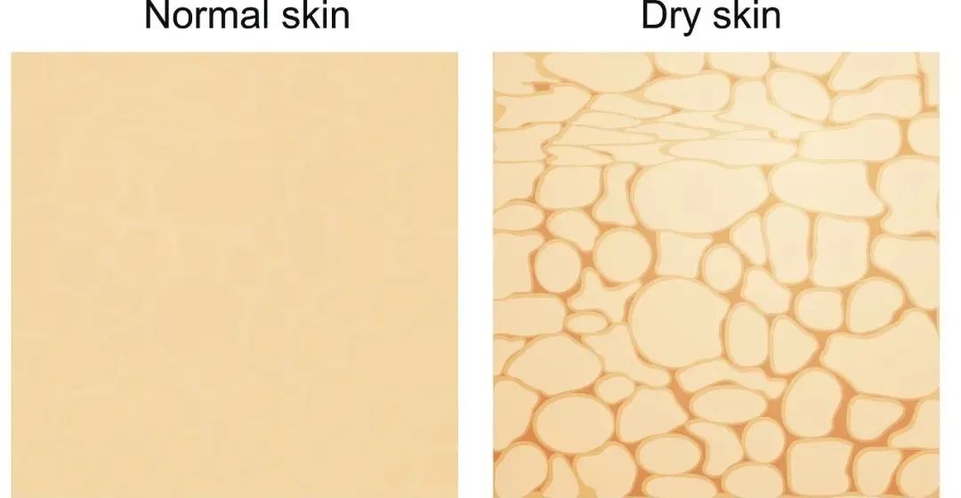 抬头纹去除真的有效吗,抬头纹法令纹真的可以消灭吗