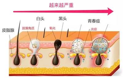 去黑头粉刺最有效的解决方法,如何正确的去黑头粉刺