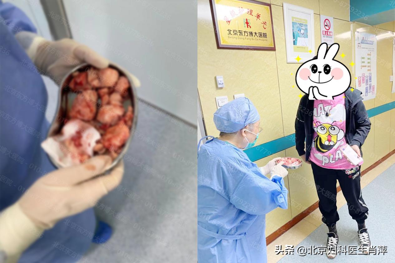 腺肌症怎么治？推荐腺肌症保宫术